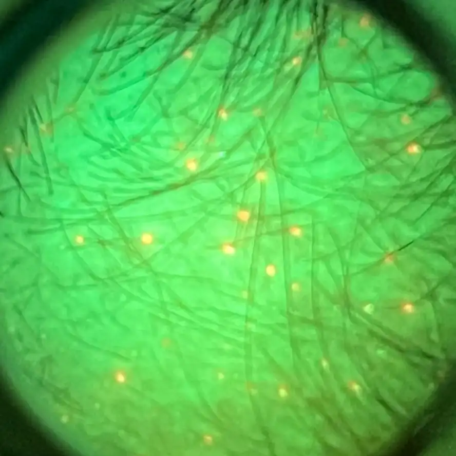 Mapeamento fluorescente do couro cabeludo — imagem 3
